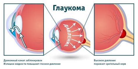 Симптомы глаукомы глаза бани: