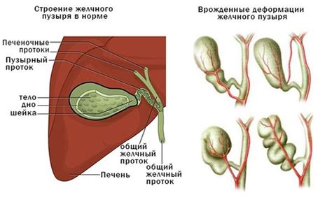 Симптомы деформации желчного пузыря