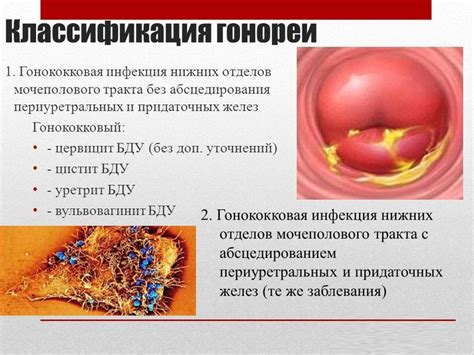 Симптомы ишиаса у женщин