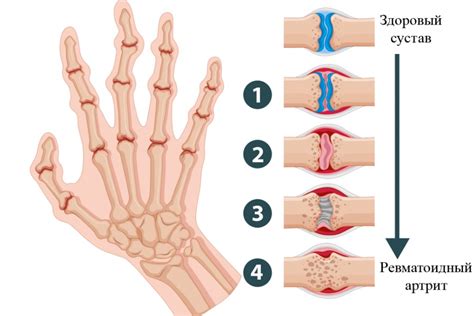 Симптомы и диагностика воспаления в суставах пальцев рук