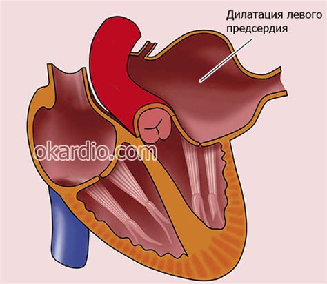 Симптомы и лечение дилатации левого предсердия