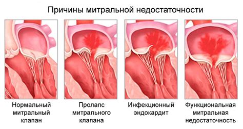 Симптомы и лечение митральной клапанной регургитации 1 степени