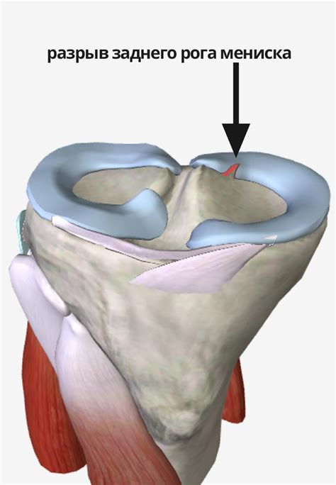 Симптомы и последствия удаления мениска коленного сустава