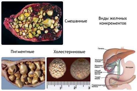 Симптомы и признаки камня в желчном пузыре