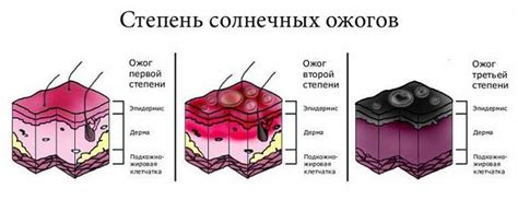 Симптомы и признаки солнечных ожогов