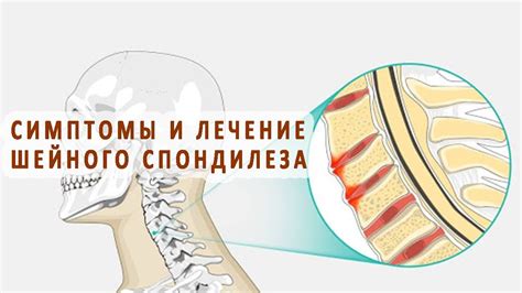 Симптомы и проявления спондилеза шейного отдела