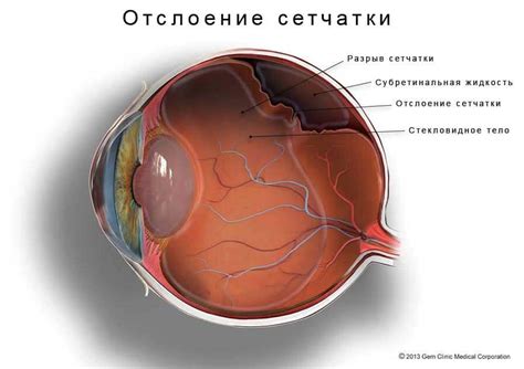 Симптомы отслоения сетчатки