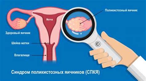 Симптомы повышенного уровня гормона ФСГ у женщин