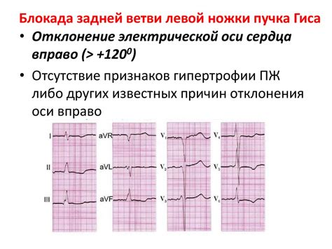 Симптомы полной блокады левой ножки пучка Гиса