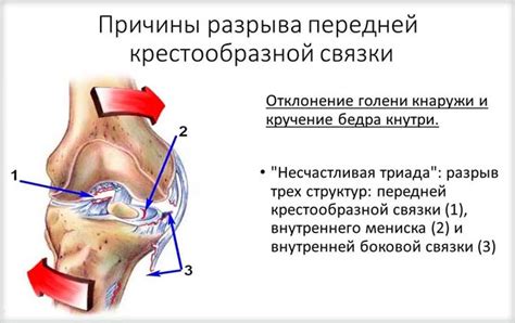 Симптомы разрыва крестообразной связки