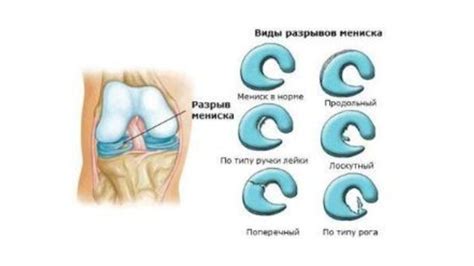 Симптомы разрыва мениска