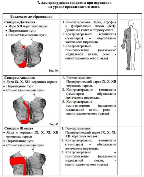 Синдром несдерженности