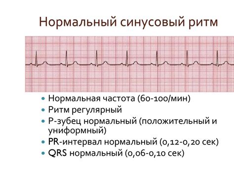 Синусовый ритм