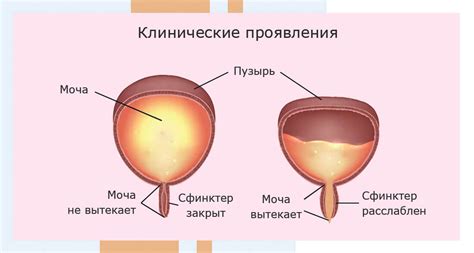 Слабый мочевой пузырь: причины и симптомы