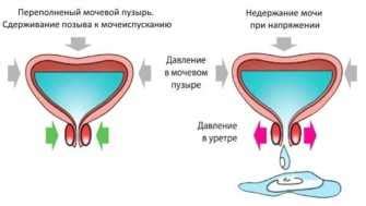 Слабый мочевой пузырь: эффективные методы лечения