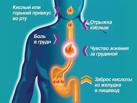 Смягчение симптомов изжоги