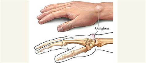 Травматические причины возникновения шишки на запястье руки