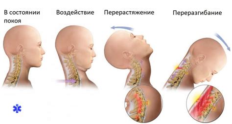 Травма шеи