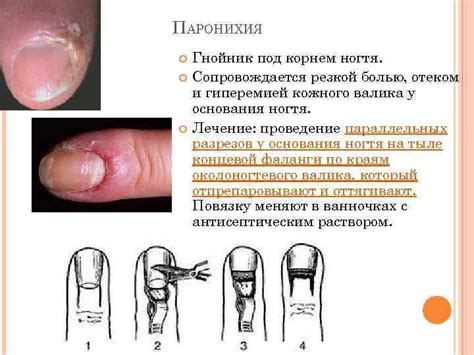 Травмы ногтевой пластины и околоногтевого валика