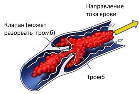 Третья причина: тромбоз сосудов в области укола