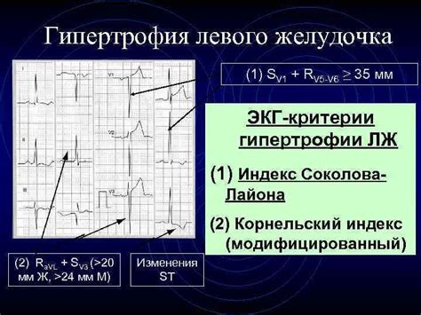 Третья часть. Диагностика гипертрофии левого желудочка