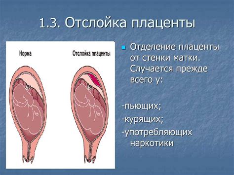 Угроза жизни матери и плода при отслойке плаценты