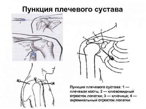 Физиотерапевтические процедуры при дистрофии плечевого сустава 1 степени