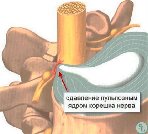 Холодовой ущемление нервов