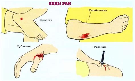 Что делать при кровоточащей ране на пальце