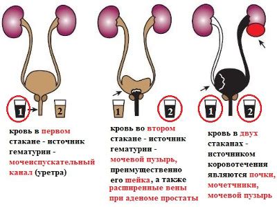 Что означает Кр в моче 5 RBC мкл?