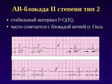 Что такое автономная блокада 2-ой степени 1-го типа?