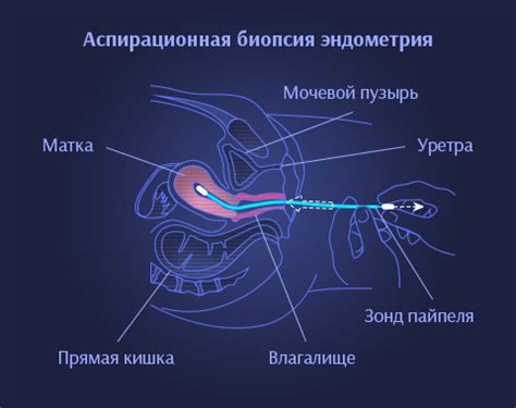 Что такое аспирационная биопсия эндометрия?