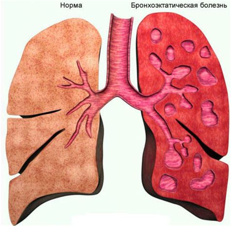 Что такое бронхоэктазы и какие симптомы они проявляют?