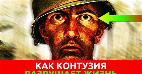 Что такое контузия головы и какие у нее последствия