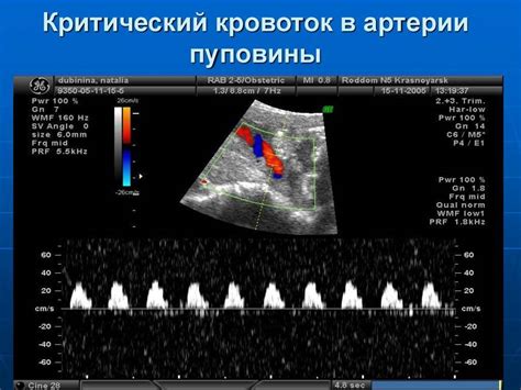 Что такое нарушение маточно плацентарного кровотока 1а