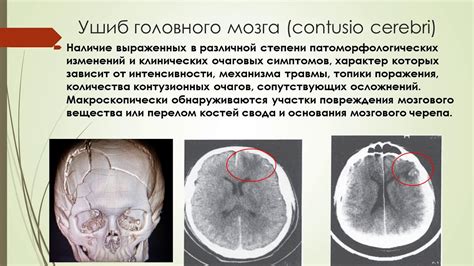 Что такое открытая проникающая черепно-мозговая травма?