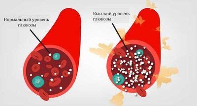 Что такое повышенная глюкоза в крови и как она возникает?