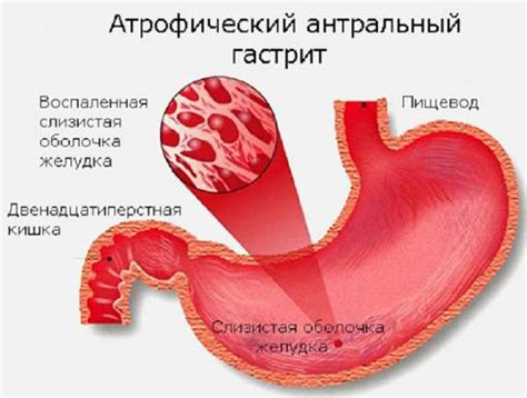 Что такое постоянная отрыжка воздухом и вздутие?