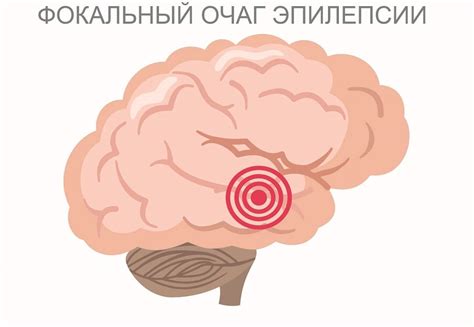 Что такое симптоматическая фокальная эпилепсия у детей?