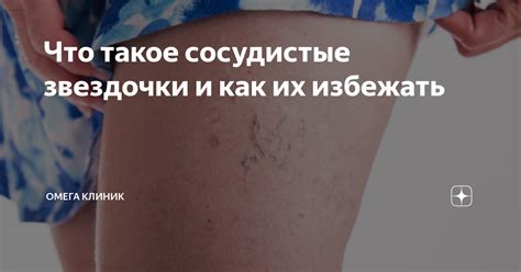 Что такое сосудистые звездочки и почему они появляются?