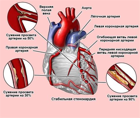 Что такое стенокардия и стабильная стенокардия?