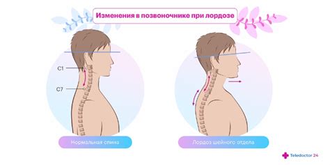 Шейный лордоз: причины, факторы и последствия