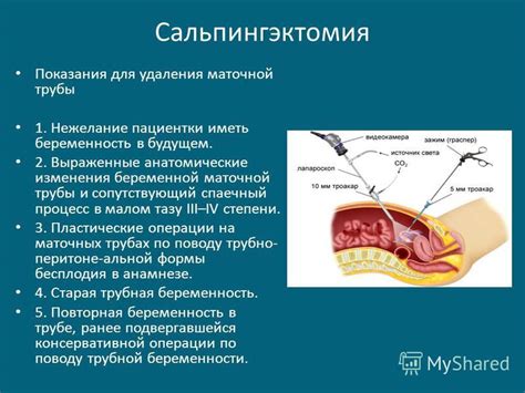 Эндометриоз: влияние на процесс удаления маточной трубы