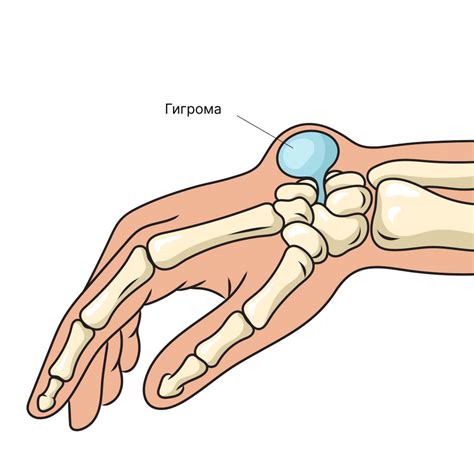 Эффективное лечение шишки на запястье руки