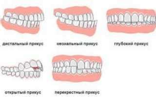 Эффективные методы коррекции неправильного прикуса у ребенка в 2 года