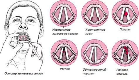  Причины и последствия повреждения голосовых связок 